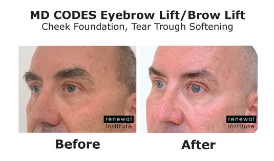 Md Codes Before And After Brow Lift Male
