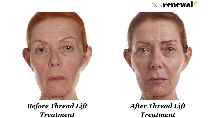 Coreen Thread Lift Face Before And After