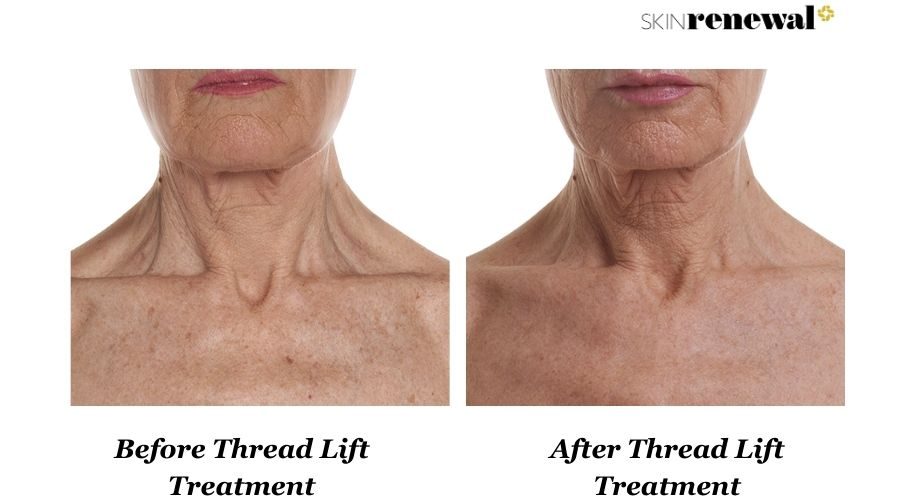 Coreen Thread Lift Neck Before And After