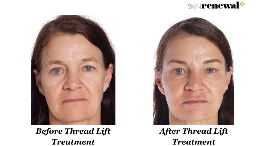 Elmarie Thread Lift Before And After