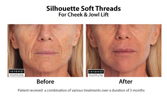 Before And After Silhouette Soft For Cheek And Jowls