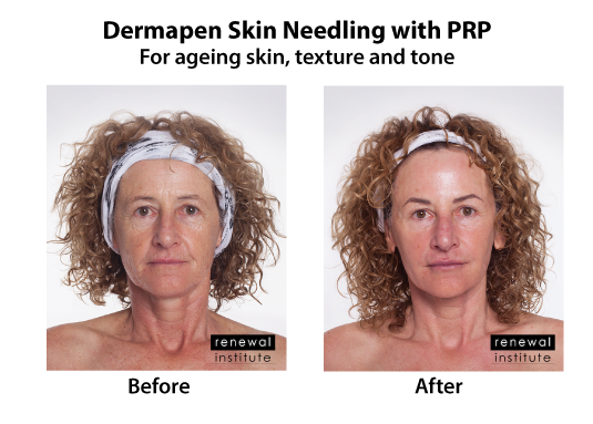 Before And After Dermapen Skin Needling With Prp Ageing Skin