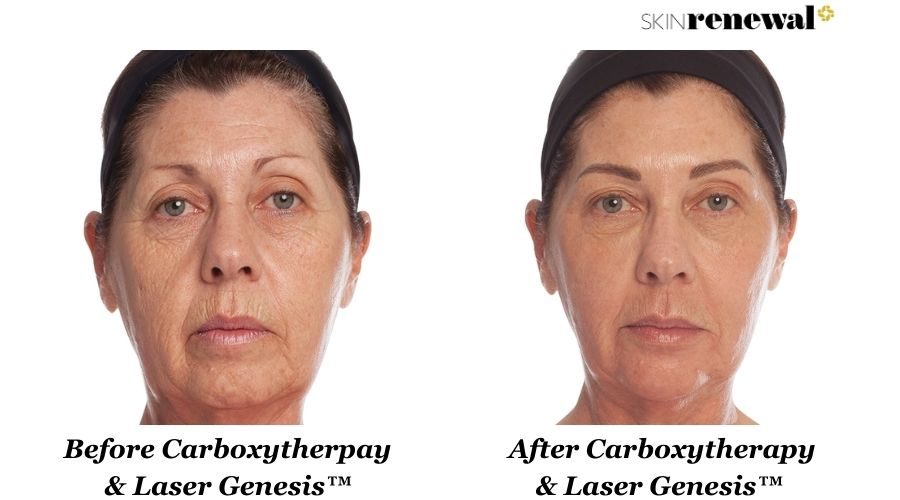 Annelise Carboxytherapy Laser Genesis Before And After