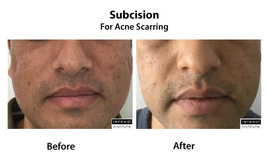Subcision For Acne