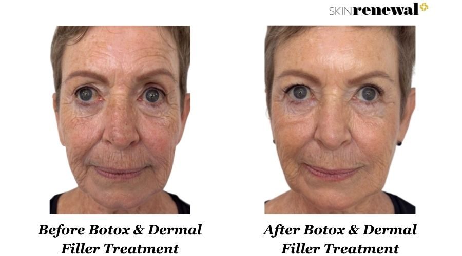 Botox Dermal Filler Front