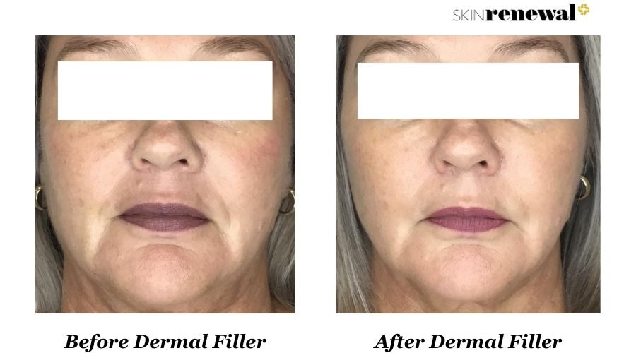 Dermal Filler Nasolabial Front