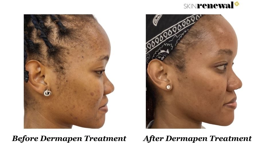 Dermapen Right Before And After