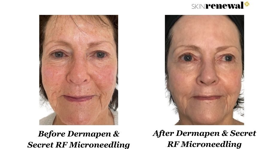 Dermapen Secret Rf Microneedling Front Before And After