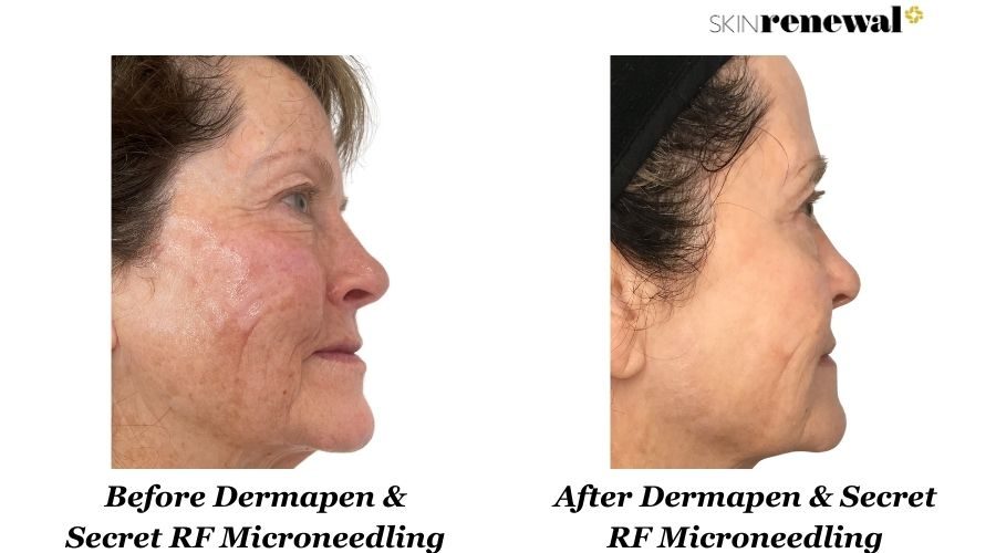 Dermapen Secret Rf Microneedling Right Before And After