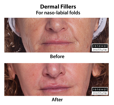 Before And After Dermal Fillers Naso Labial Folds