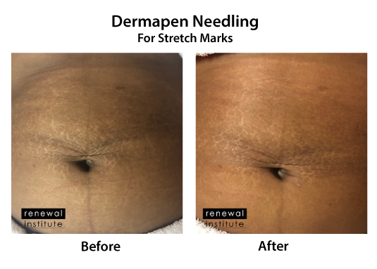Dermapen Skin Needling For Stretch Marks Male