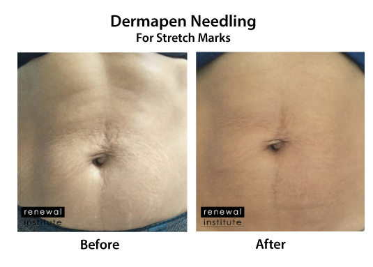 Dermapen Skin Needling For Stretch Marks