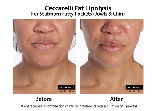 Optimize fat reduction with lipolytic injections in South Africa