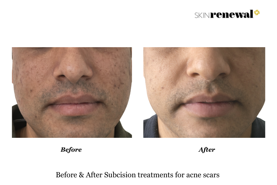 Acne Scars Subcision Before and After