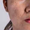 Melasma Explained. A MUST WATCH!