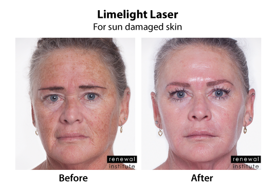 Before And After Limelight Laser Sun Damage And Rosacea Redness 2