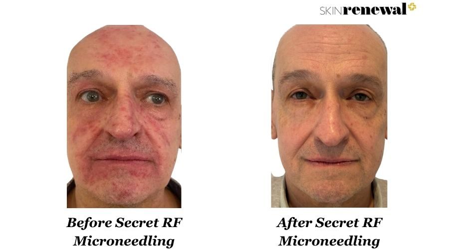 Secret Rf Microneedling Front