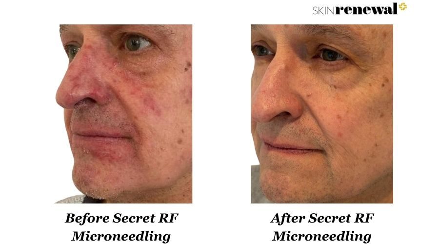 Secret Rf Microneedling Left