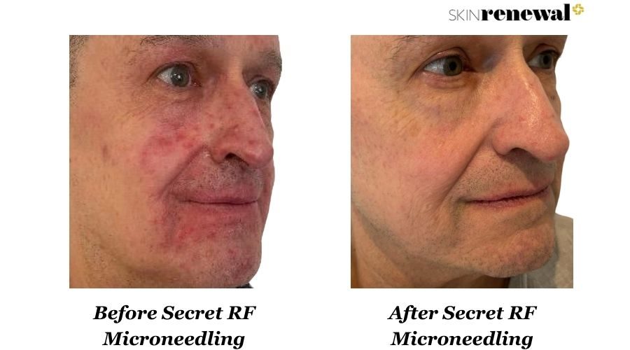 Secret Rf Microneedling Right