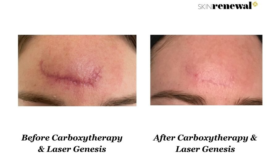 Carboxytherapy Laser Genesis Scar Before And After