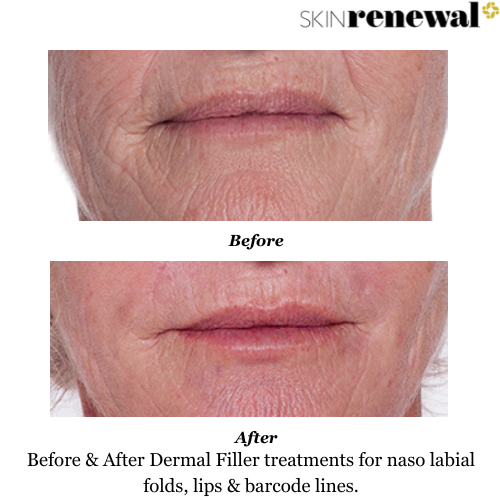 Thin Lips Barcode Lines Dermal Fillers Before and After