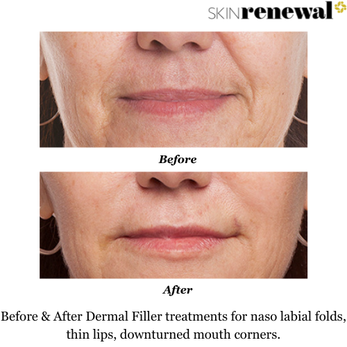 Thin Lips Dermal Fillers Before and After