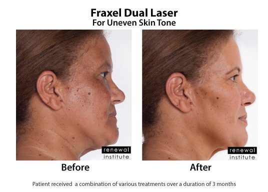 Fraxel Before And After 3