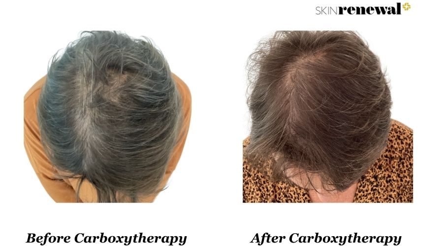 Carboxytherapy Scalp Before And After 1