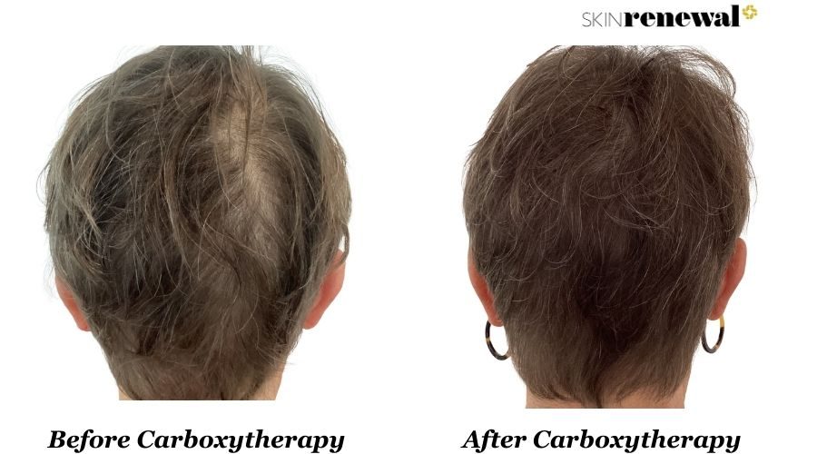 Carboxytherapy Scalp Before And After 2