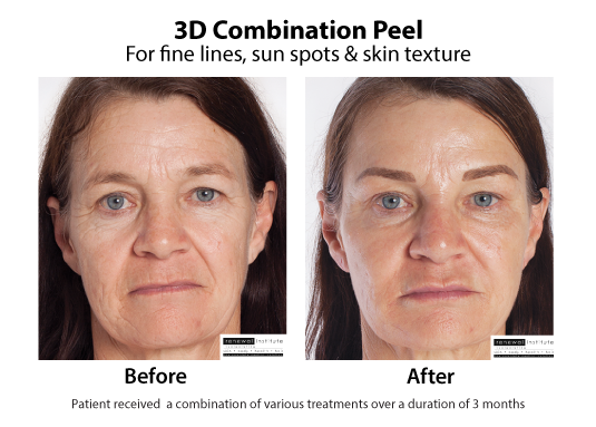 Before And After 3d Peels Fine Lines Sun Spots 1