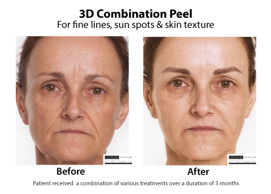 Before And After 3d Peels Fine Lines Sun Spots