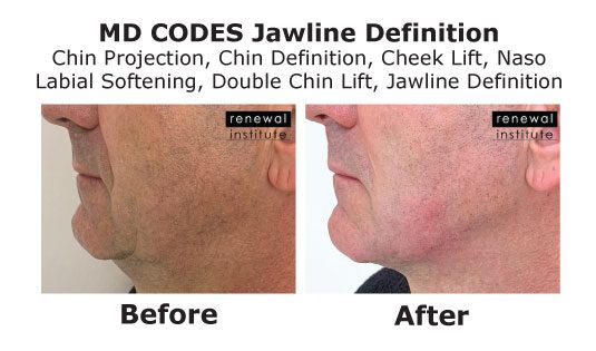 Md Codes Before And After Jawline Definition Male