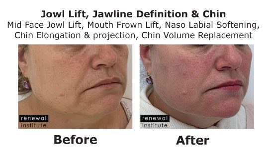 Md Codes Before And After Jowl Jawline And Chin Definition Female