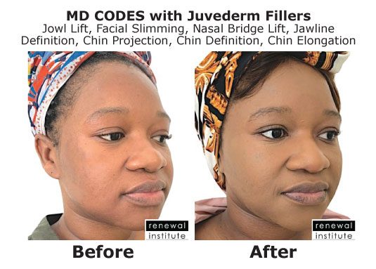 Md Codes Before And After Jowl Jawline And Chin Projection Female