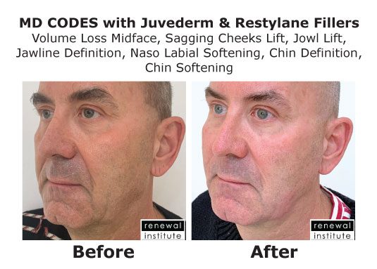 Md Codes Before And After Male Using Fillers