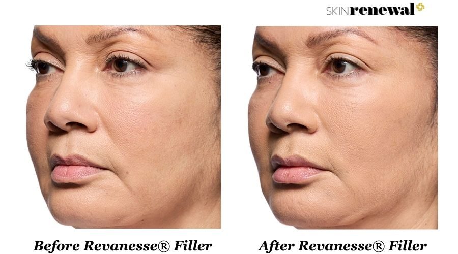 The Science Behind Revanesse® Dermal Fillers at Skin Renewal