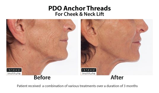 Before And After Pdo Anchor Threads For Cheek Neck Lift