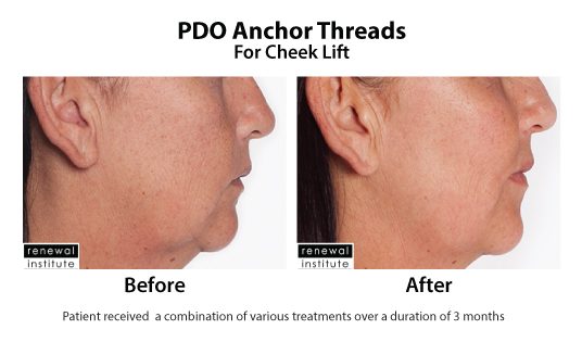 Before And After Pdo Threads For Cheecklift 1