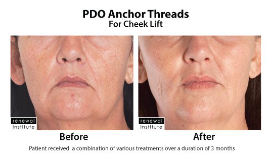 Before And After Pdo Threads For Cheek Lift 3
