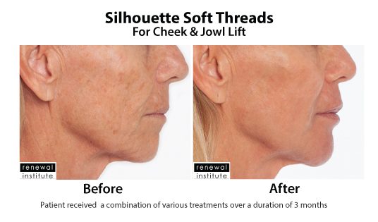 Before And After Silhouette Soft For Cheek And Jowls 2