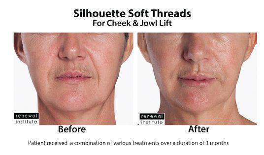 Before And After Silhouette Soft For Cheek And Jowls 3
