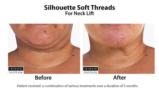 Before And After Silhouette Soft For Neck Lift 2