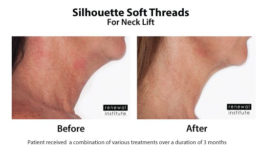 Before And After Silhouette Soft Threads For Neck Lift