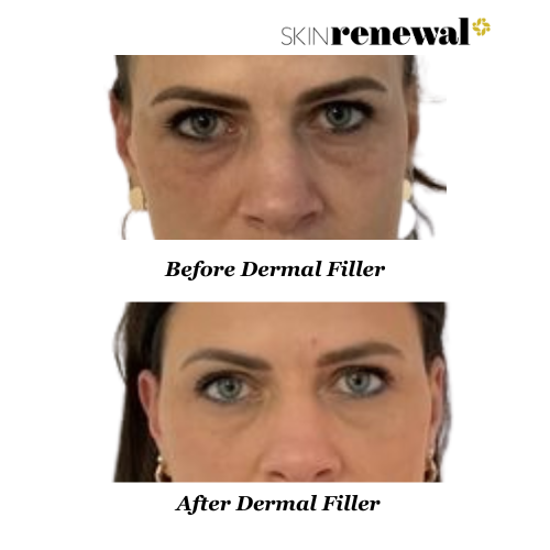 Dermal Filler Eyes Cheeks