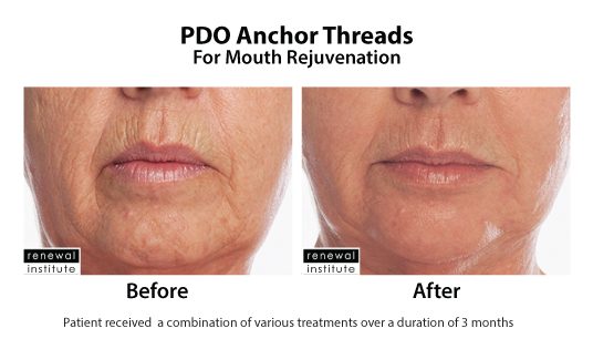 Before And After Pdo Threads For Mouth Rejuvenation