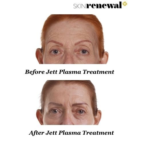 Coreen Before And After Jett Plasma