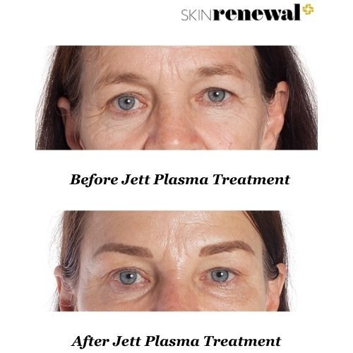 Elmarie Before And After Jett Plasma