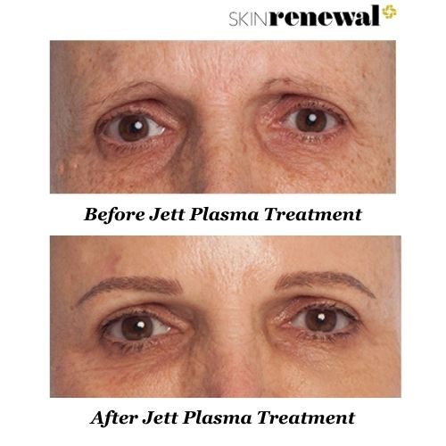 Liana Before And After Jett Plasma