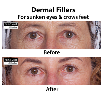 Before And After Dermal Fillers Sunken Eyes And Crows Feet