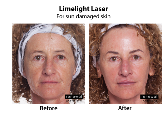 Before And After Limelight Laser Sun Damage And Rosacea Redness